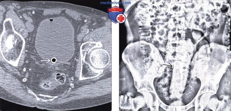 Рентгенограмма, КТ брюшной полости при инородном теле