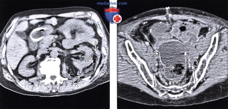 Рентгенограмма, КТ брюшной полости при инородном теле