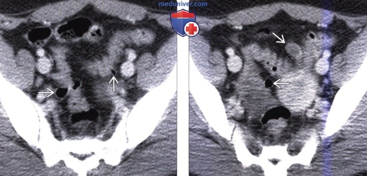 Рентгенограмма, КТ при дивертикулезе толстой кишки