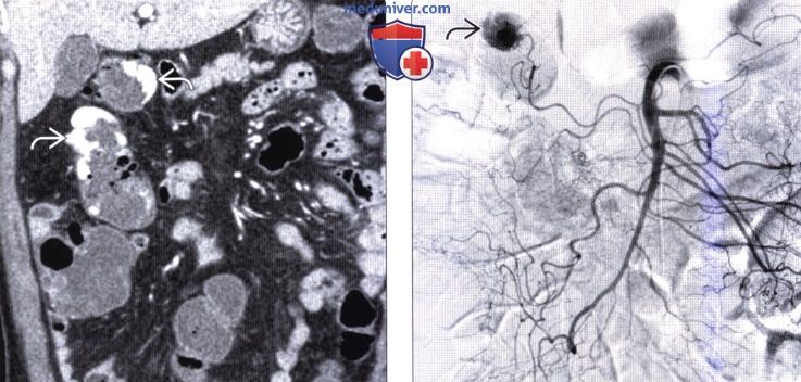 Рентгенограмма, КТ при дивертикулезе толстой кишки