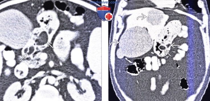 Рентгенография, КТ при интрамуральной доброкачественной опухоли желудка