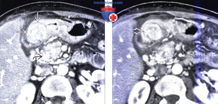 Рентгенография, КТ при интрамуральной доброкачественной опухоли желудка