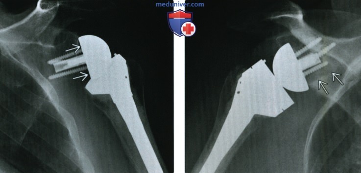 Рентгенограмма, КТ эндопротеза плечевого сустава