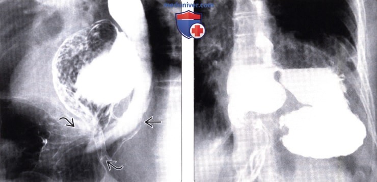 Рентгенограмма, КТ при грыже пищеводного отверстия диафрагмы (ГПОД)