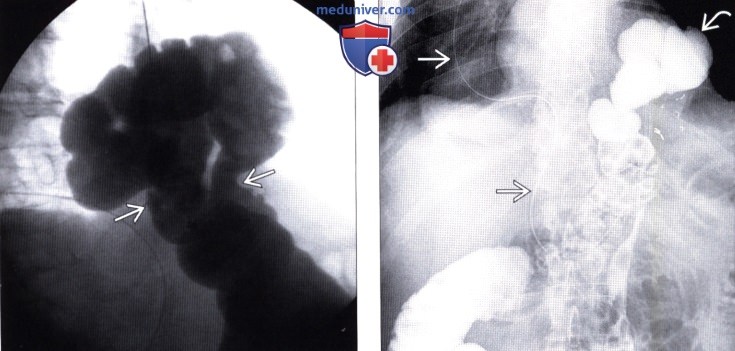 Рентгенограмма, КТ при грыже пищеводного отверстия диафрагмы (ГПОД)