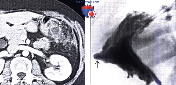 Рентгенография, КТ при язве желудка