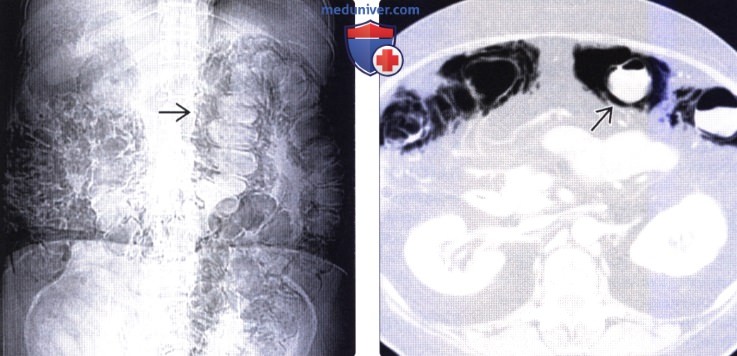 Рентгенограмма, КТ при интестинальном пневматозе