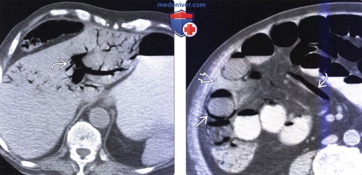 Рентгенограмма, КТ при интестинальном пневматозе