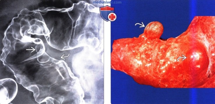 rentgen kt intestinalnogo pnevmatoza 3