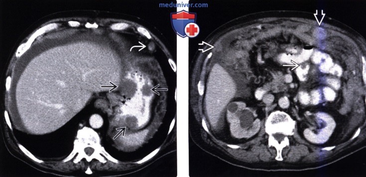 Рентгенограмма, КТ при метастазе в стенку тонкой кишки и лимфоме тонкой кишки