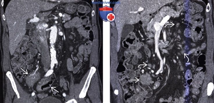 Рентгенограмма, КТ при метастазе в стенку тонкой кишки и лимфоме тонкой кишки