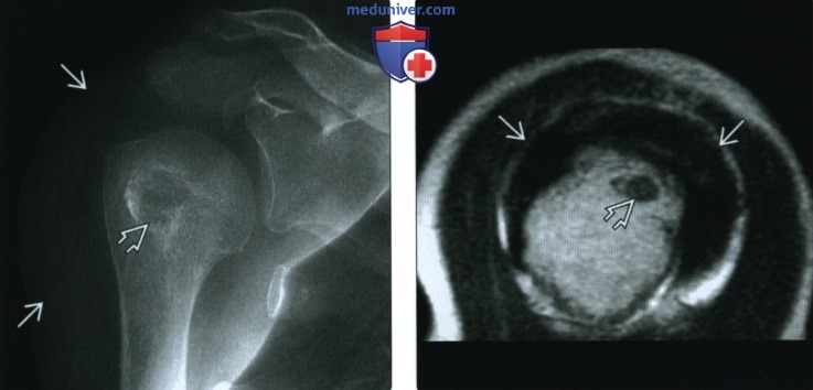Рентгенограмма, КТ, МРТ при амилоидозе суставов, связок