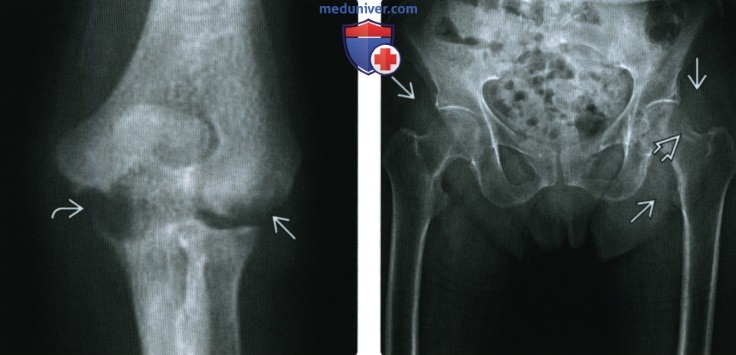 Рентгенограмма, КТ, МРТ при амилоидозе суставов, связок