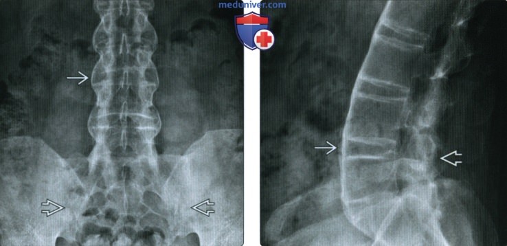 Рентгенограмма, КТ, МРТ при артрите из-за воспалительного заболевания кишечника