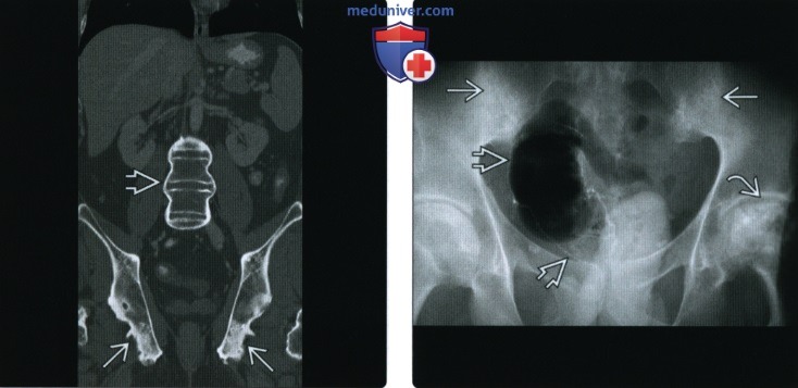 Рентгенограмма, КТ, МРТ при артрите из-за воспалительного заболевания кишечника