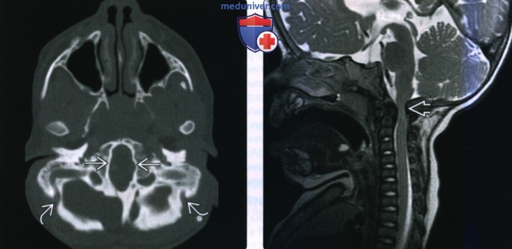 Рентгенограмма, КТ, МРТ при ахондроплазии