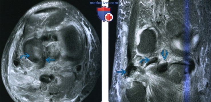 Рентгенограмма, КТ, МРТ при бедренно-большеберцовом вывихе