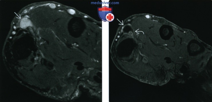 Рентгенограмма, КТ, МРТ при редких болезнях, симулирующих опухоль мягких тканей