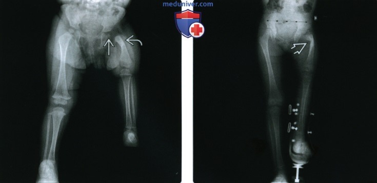 Рентгенограмма, КТ, МРТ при дефекте развития проксимальных отделов бедренной кости
