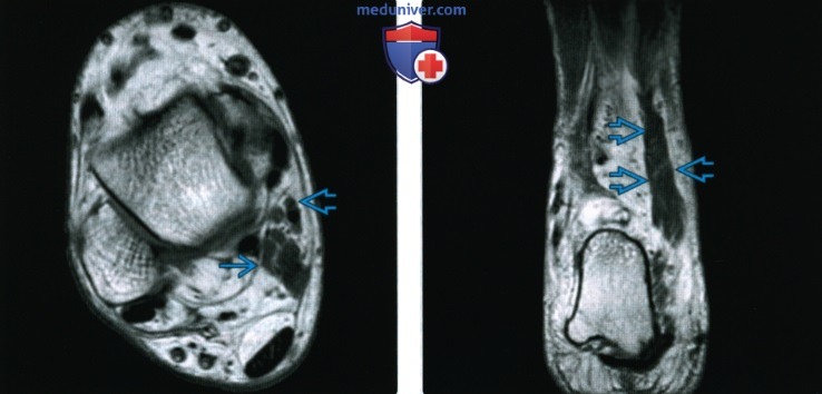 Рентгтенограмма, КТ, МРТ при добавочных мышцах голеностопного сустава и стопы
