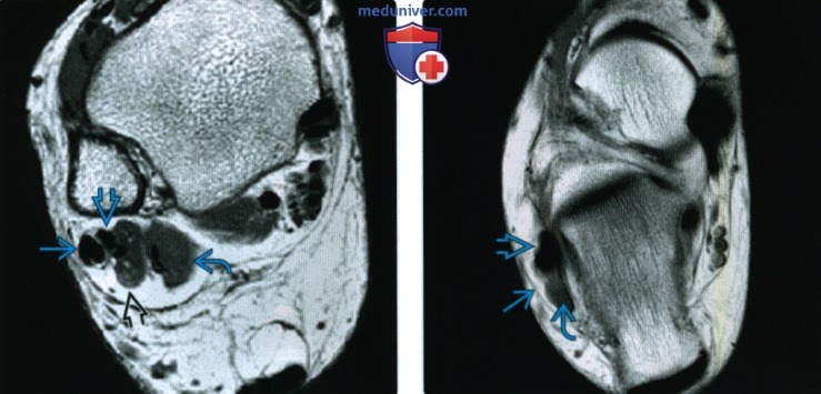 Рентгтенограмма, КТ, МРТ при добавочных мышцах голеностопного сустава и стопы