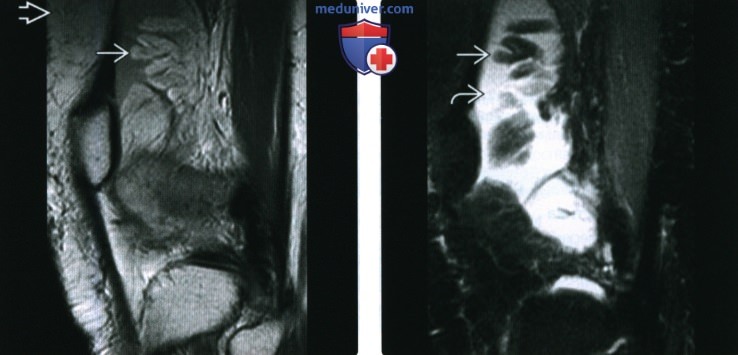 Рентгенограмма, КТ, МРТ при древовидной липоме коленного сустава