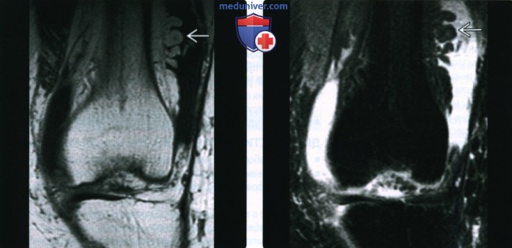 Рентгенограмма, КТ, МРТ при древовидной липоме коленного сустава