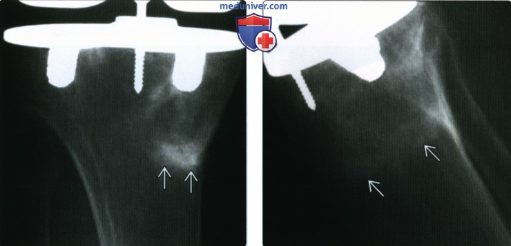 Рентгенограмма, КТ, МРТ эндопротеза коленного сустава