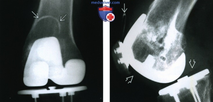 Рентгенограмма, КТ, МРТ эндопротеза коленного сустава