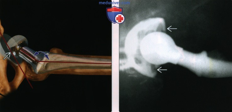Рентгенограмма, КТ, МРТ эндопротеза тазобедренного сустава
