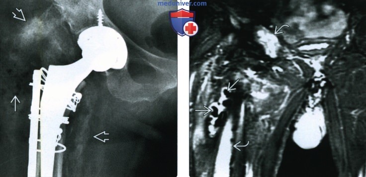 Рентгенограмма, КТ, МРТ эндопротеза тазобедренного сустава