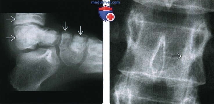 Рентгенограмма, КТ, МРТ при эностозе (костном островке)