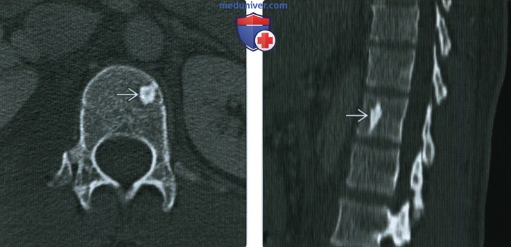 Рентгенограмма, КТ, МРТ при эностозе (костном островке)