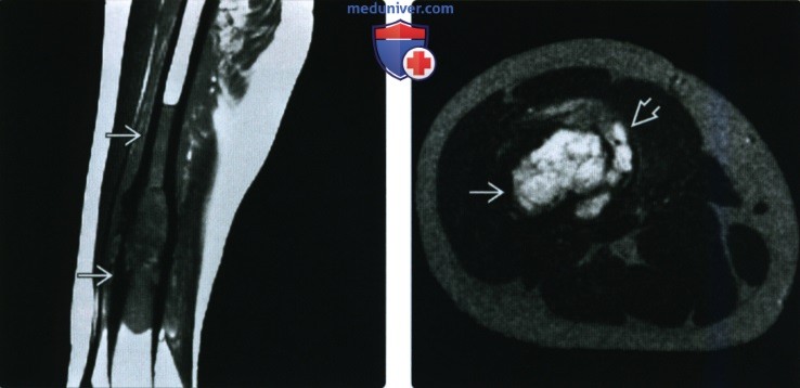 Рентгенограмма, КТ, МРТ при злокачественной фиброзной гистиоцитоме кости