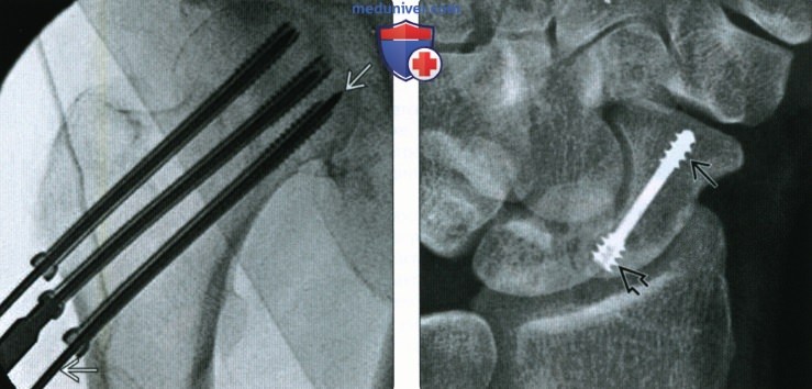 Рентгенограмма, КТ, МРТ при фиксации кости винтами