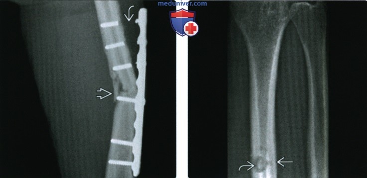 Рентгенограмма, КТ, МРТ при фиксации кости винтами