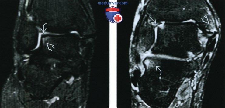Рентгенограмма, КТ, МРТ при фрагментировании суставных поверхностей голеностопного сустава