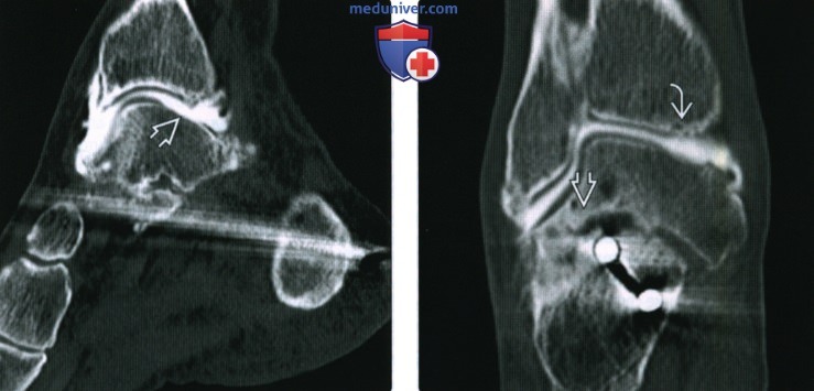 Рентгенограмма, КТ, МРТ при фрагментировании суставных поверхностей голеностопного сустава