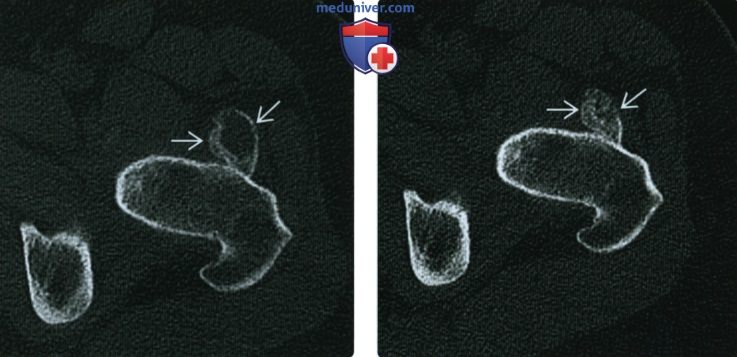 Рентгенограмма, КТ, МРТ при оссифицирующем миозите (гетеротопической оссификации)