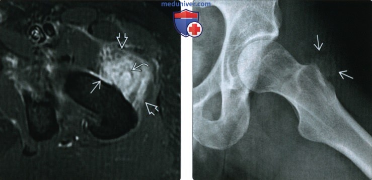 Рентгенограмма, КТ, МРТ при оссифицирующем миозите (гетеротопической оссификации)