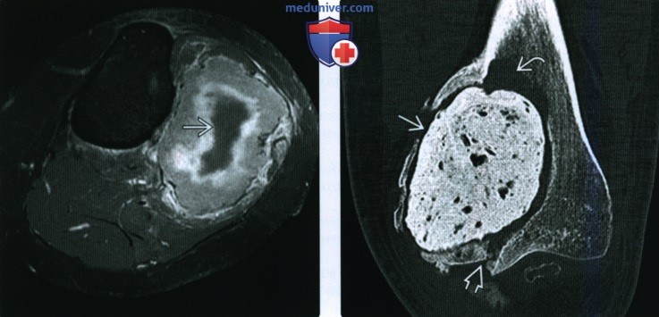 Рентгенограмма, КТ, МРТ при гигантоклеточной опухоли