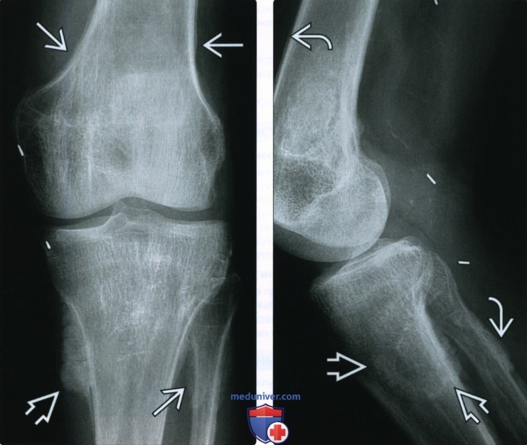 Рентгенограмма, КТ, МРТ при гипертрофической остеоартропатии