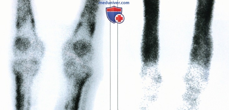 Рентгенограмма, КТ, МРТ при гипертрофической остеоартропатии