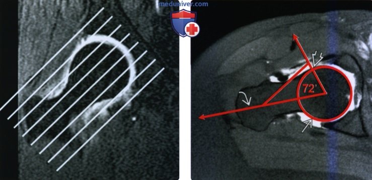 Рентгенограмма, КТ, МРТ при импинджмент-синдроме тазобедренного сустава