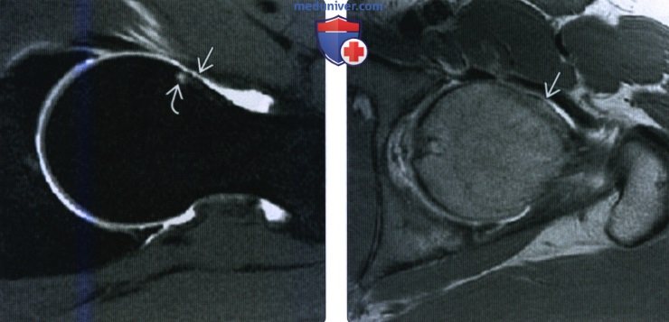 Рентгенограмма, КТ, МРТ при импинджмент-синдроме тазобедренного сустава