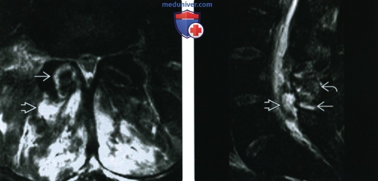 Рентгенограмма, КТ, МРТ при инфекционном заболевании позвоночника