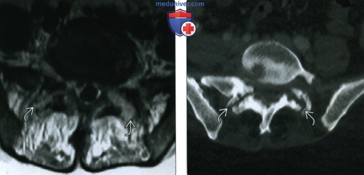 Рентгенограмма, КТ, МРТ при инфекционном заболевании позвоночника
