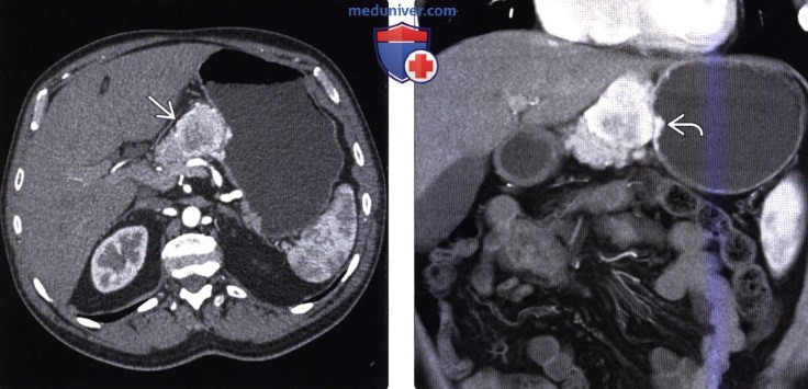 Рентгенограмма, КТ, МРТ при карциноиде (карциноидной опухоли) желудочно-кишечного тракта