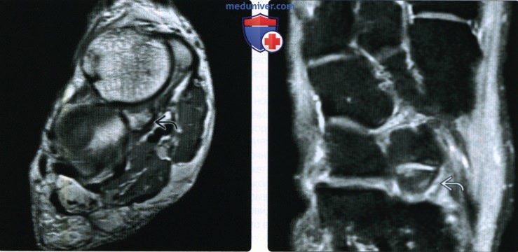 Рентгенограмма, КТ, МРТ добавочных костей голеностопного сустава и стопы