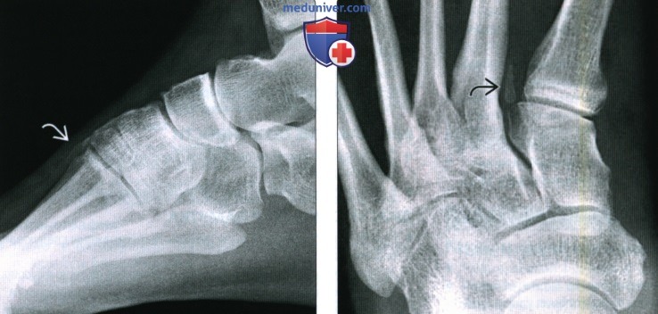 Рентгенограмма, КТ, МРТ добавочных костей голеностопного сустава и стопы